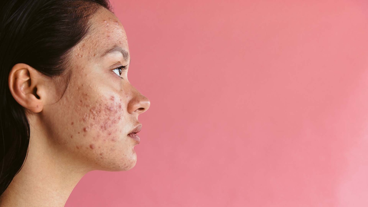 Dubai's Premier Acne Treatments: A Closer Look