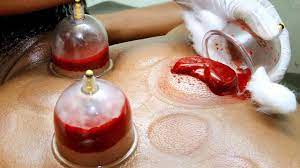 What Conditions Can Hijama Treat?