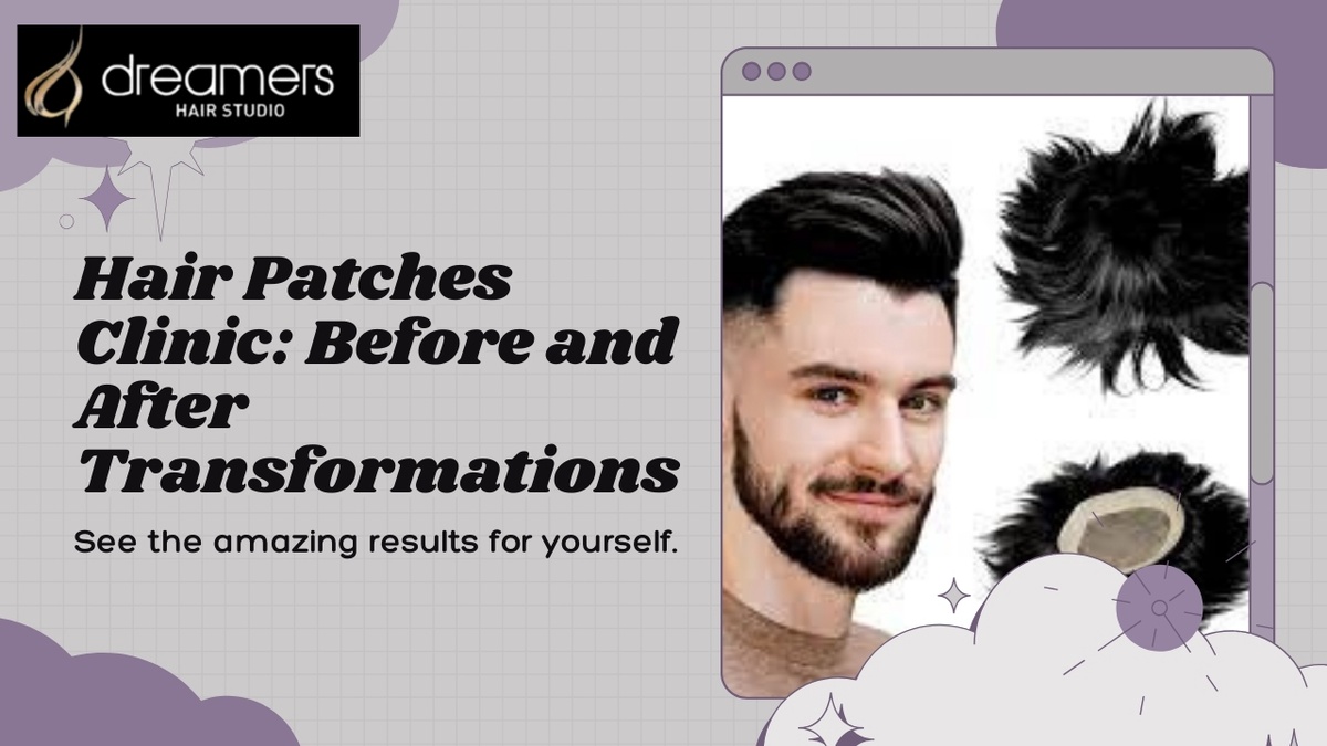 Your Trusted Hair Restoration Destination in Chandigarh and Mohali