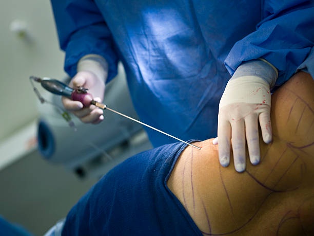 Reveal a New You: Laser Liposuction in Abu Dhabi
