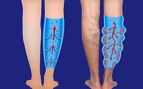 The Connection between Varicose Veins and Cardiovascular Health