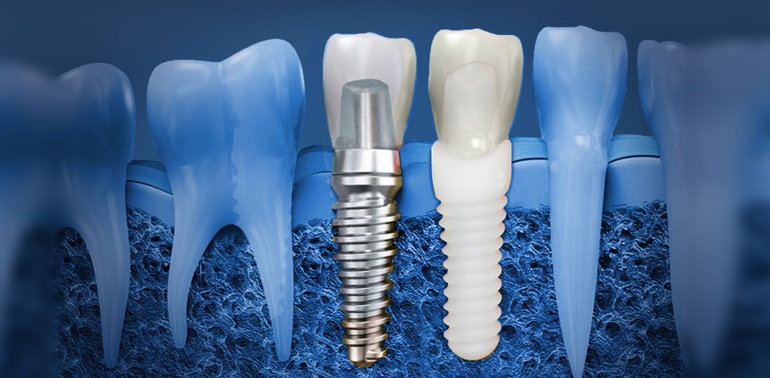Maintaining Oral Hygiene After Getting Dental Implants: Tips and Tricks
