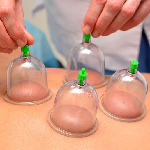 5 Things You Should Know About Hijama Treatment