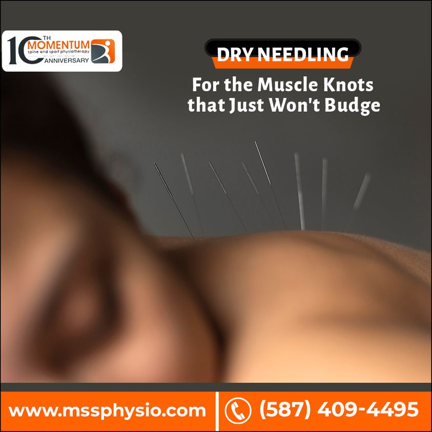 Considering Dry Needling Therapy in Edmonton? Your Complete Guide