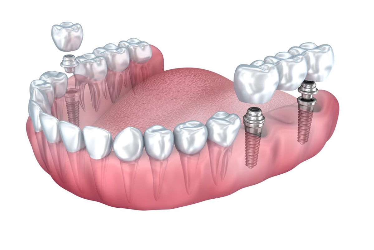 Getting A Dental Implant In London, What You Need To Understand