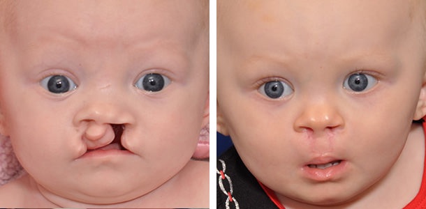Repairing Nature's Divide: The Life-Changing Impact of Cleft Palate Surgery