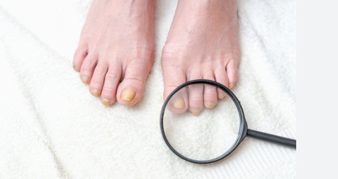 OVERCOMING ONYCHOMYCOSIS REVIEWS FOR CURING FUNGAL INFECTION