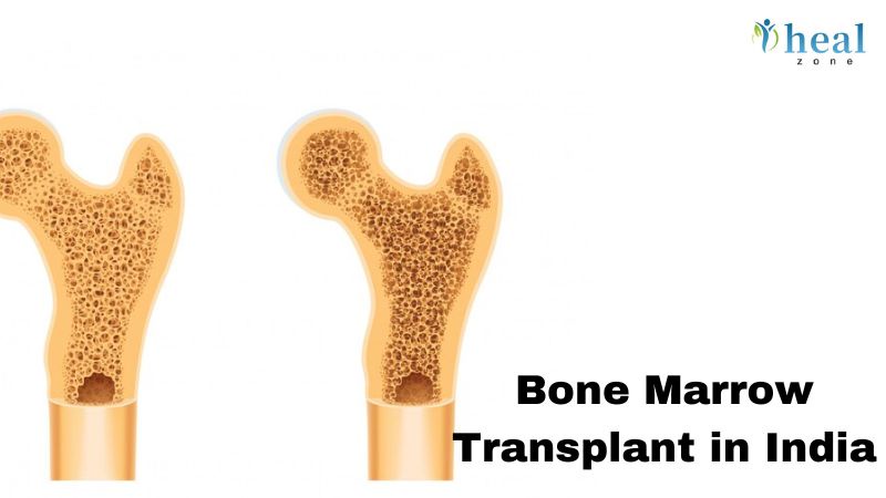 Restoring Your Health: The Benefits of Bone Marrow Transplantation