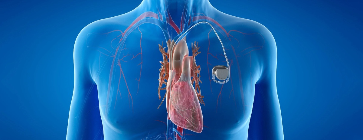 Can Having a Pacemaker Qualify for Social Security Disability and SSI?