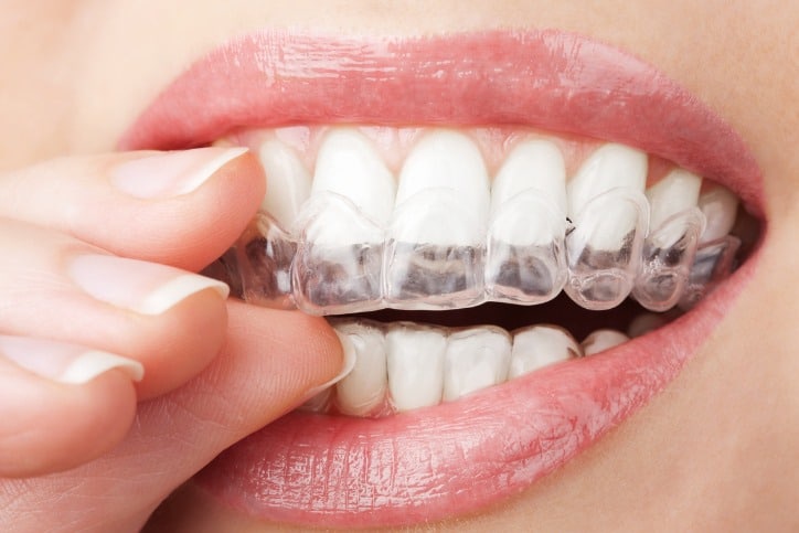 How Much Does Invisalign Costs In New York City?