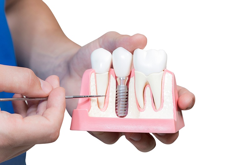 Dental Implants - The Foundation for Replacement Teeth That Look, Feel and Function Like Natural Teeth