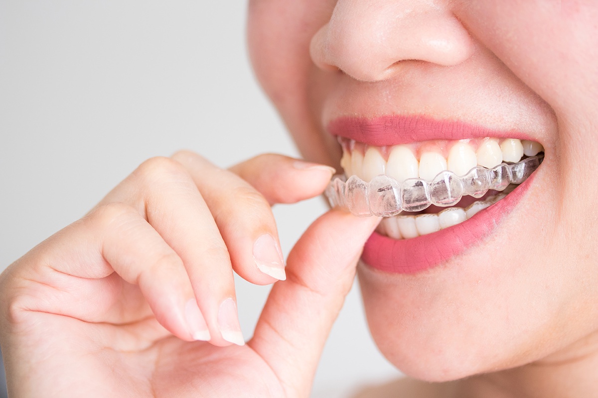 How Braces Can Improve Your Bite and Jaw Alignment