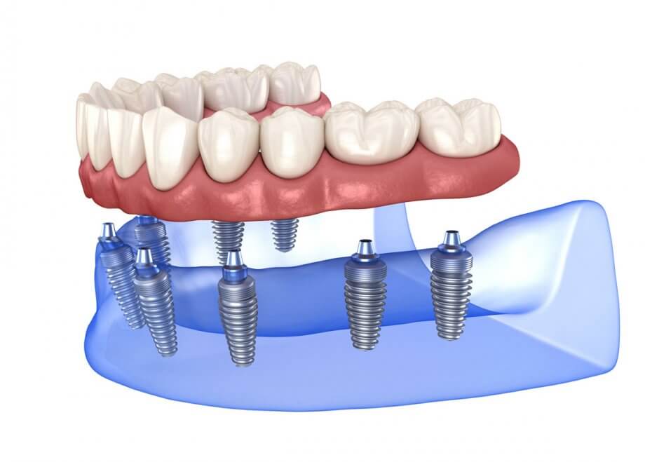 Dental Implant Cost - Thibodaux La