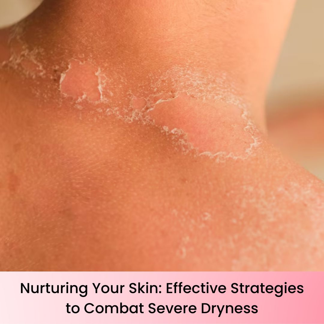 Nurturing Your Skin: Effective Strategies to Combat Severe Dryness