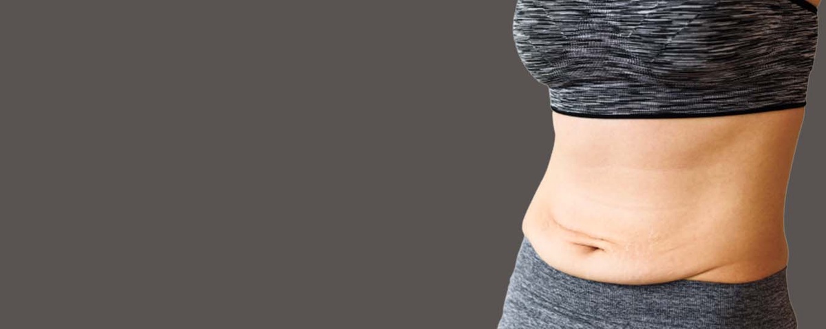 Tummy Tuck Surgery - Procedure, Benefits, Side-effects and Cost