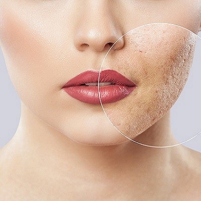 Effective Acne Scar Treatment in Islamabad: A Comprehensive Guide