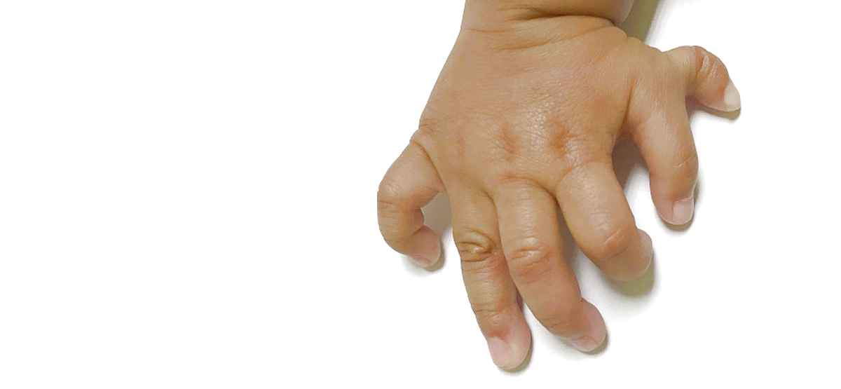 What Are Congenital Hand Deformities and What Can Be Done About Them?