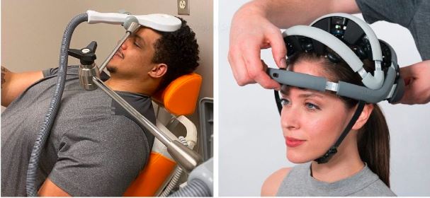 Top 5 Benefits of Transcranial Magnetic Stimulation for Anxiety