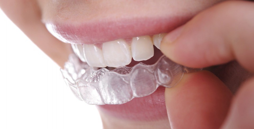 Minor Issues due to Invisalign