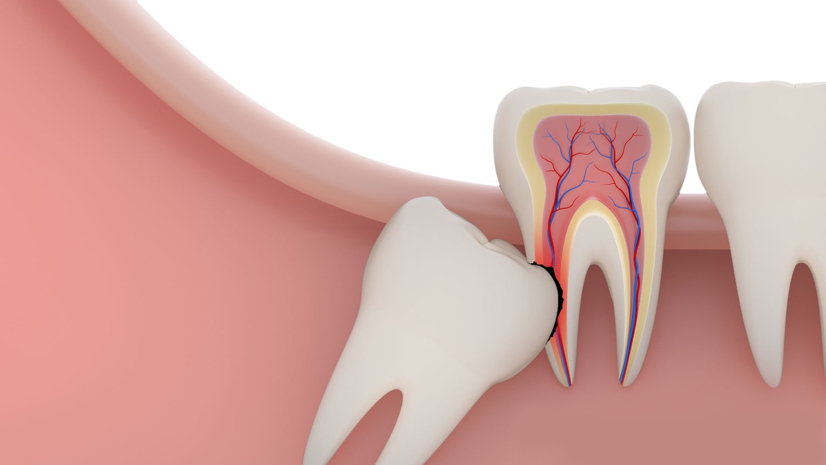 Tips for Selecting Wisdom Teeth Extraction Services in Windsor