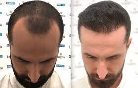 Cost vs. Quality: Making Informed Choices for Hair Transplantation