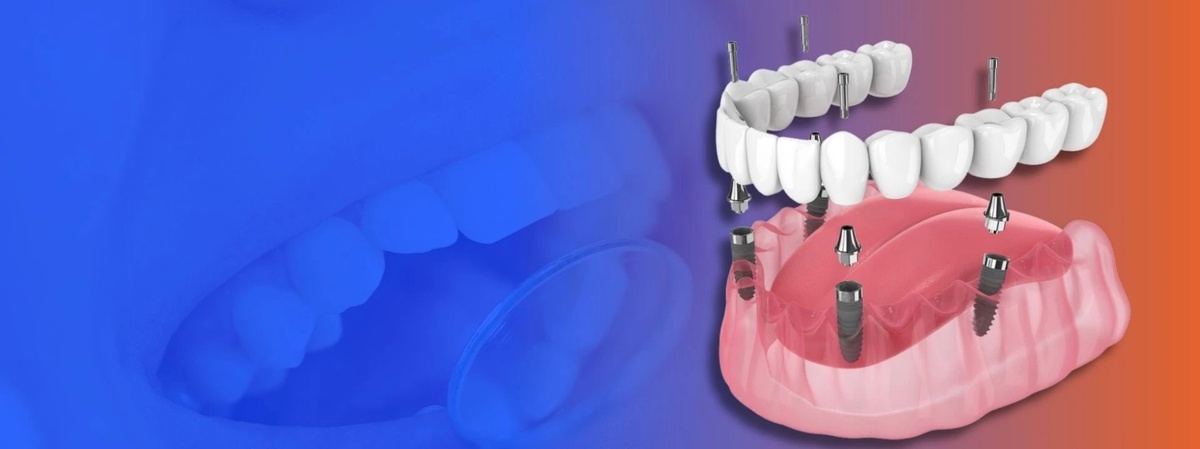 Why is the Cost of Dental Implants in India so low?