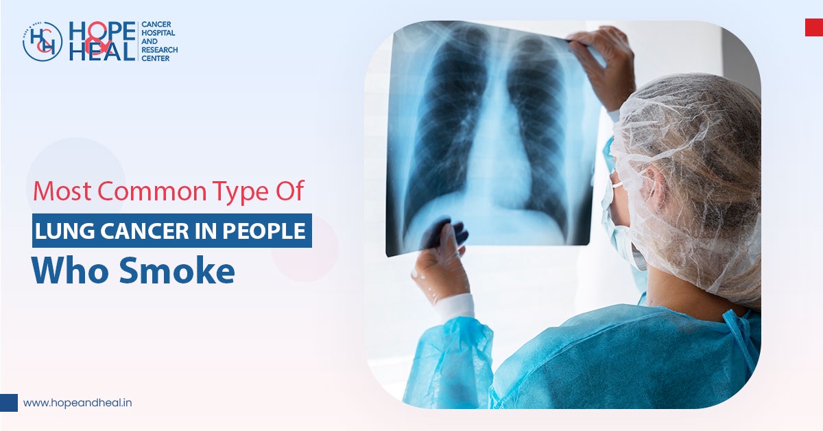 Most Common Type of Lung Cancer in People Who Smoke