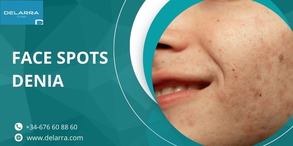 The Ultimate Face Spots Denia Treatment Guide: 5 Proven Methods