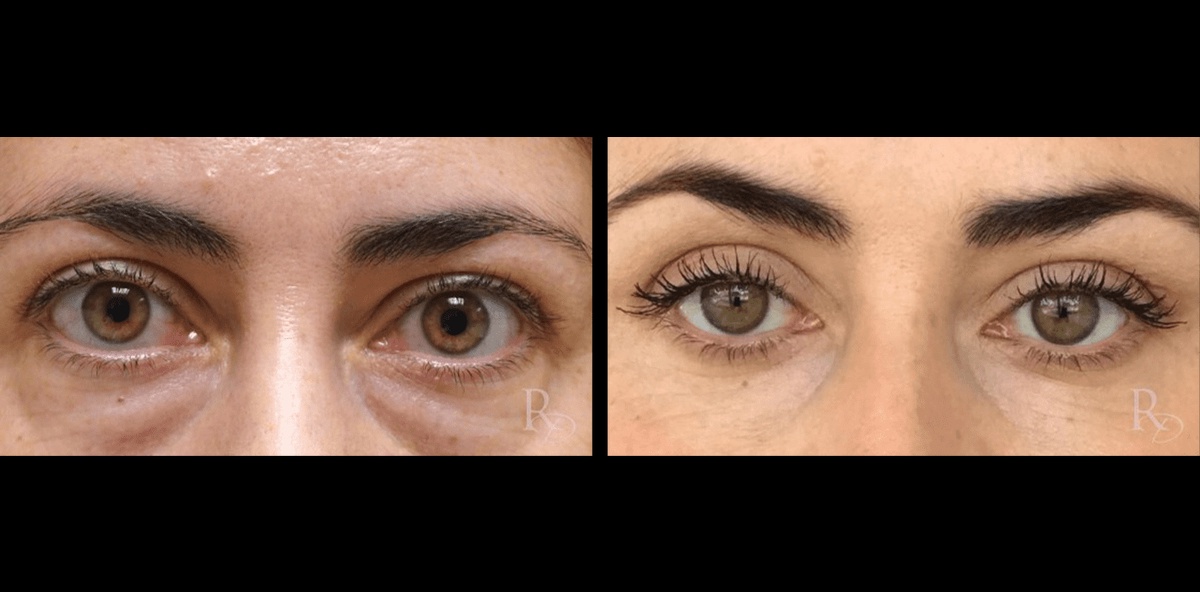The Impact of Eyelid Lift Surgery on Vision: Improving Sight and Enhancing Aesthetics