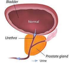 Avail Latest and Effective Bladder Cancer Treatment in Melbourne