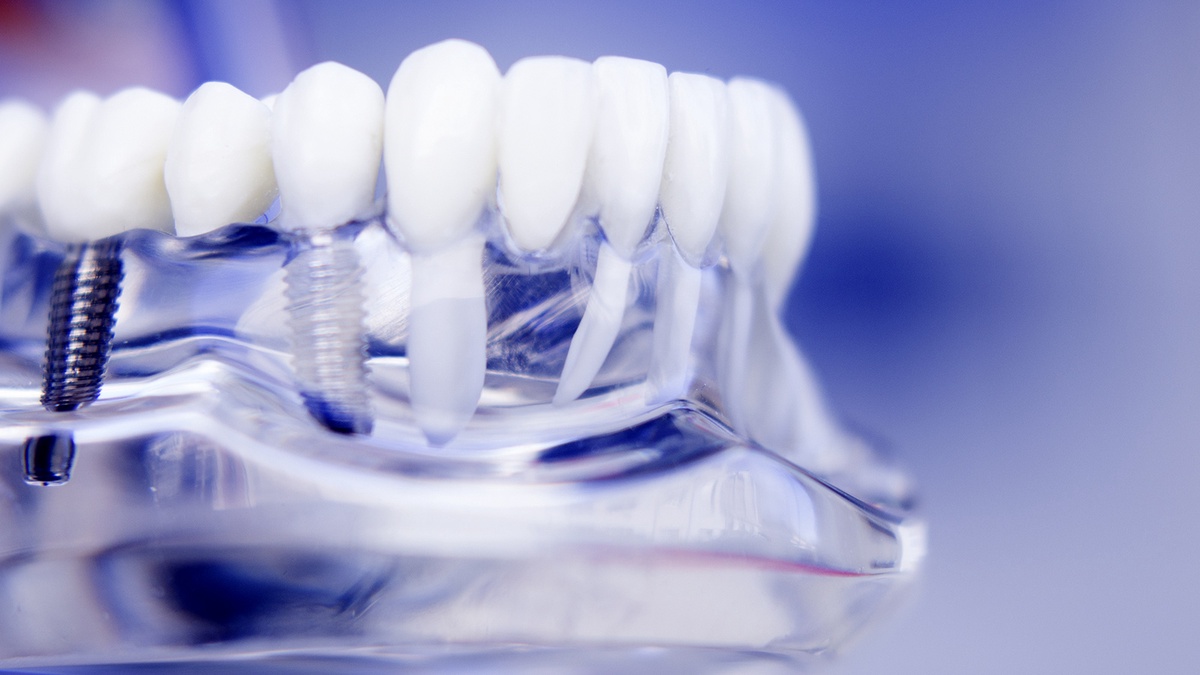 Smile Restoration 101: Exploring Dental Implants as a Solution