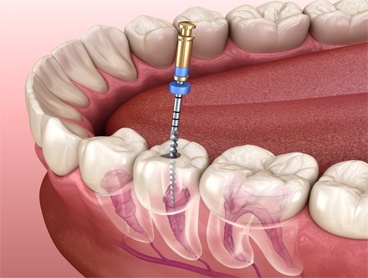 Root Canal Treatment: Cost and Benefits in Dubai
