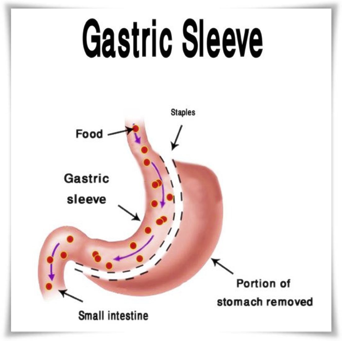 Finding Perfection: Selecting the Ideal Specialist for Gastric Sleeve Surgery