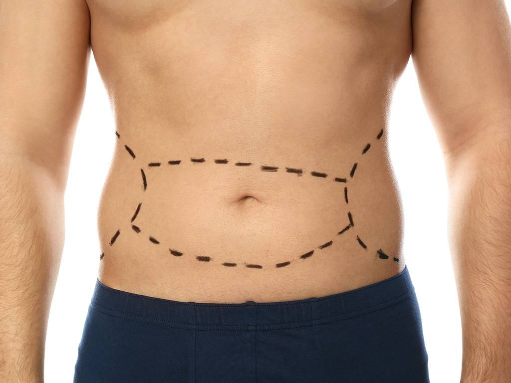 Experience Transformation: Tummy Tuck Surgery in Dubai with Dr. Anshu