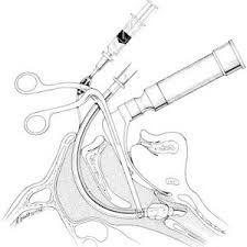 Navigating Management: The Power of Magill Forceps