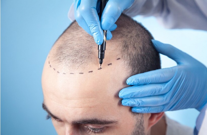 The Istanbul Experience: Transformative Hair Transplant Solutions