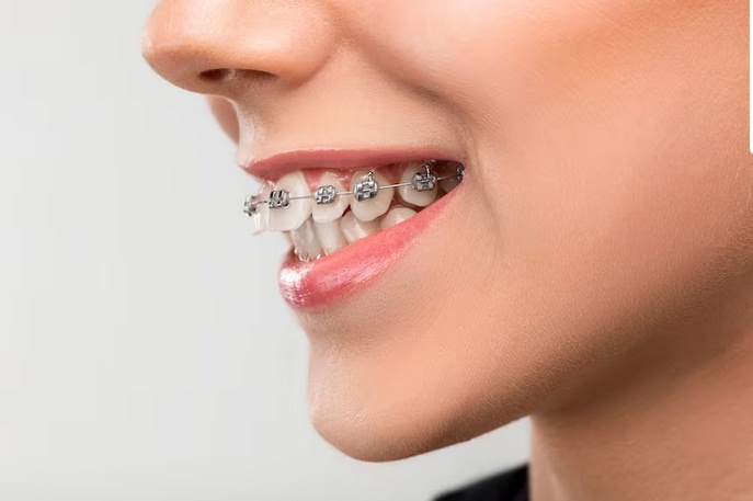 Finding Top Quality Dental Implants Near You: Your Go-To Guide