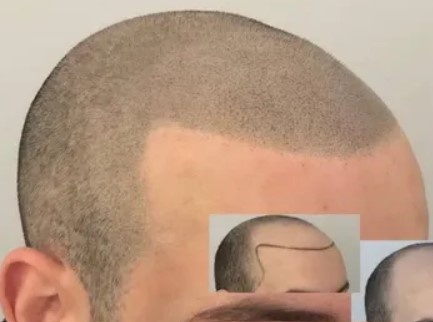 Developing Your Career With Courses In Scalp Micropigmentation: Know Here