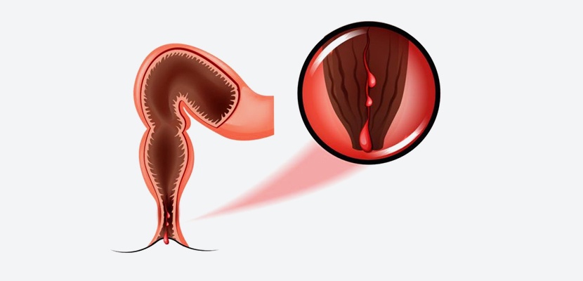Comprehensive Guide to Anal Fissure Treatment in Noida