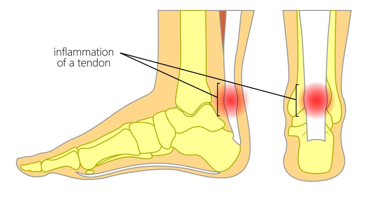Should you wear compression socks for Achilles tendonitis?