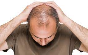 Dubai's Hair Loss Treatment Options: A Comprehensive Guide