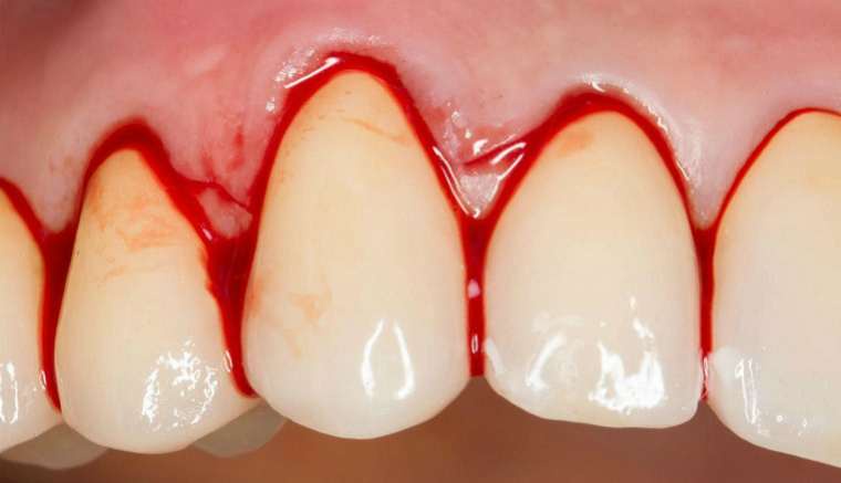 Gum Bleeding: A Closer Look at Gingivitis and Periodontitis