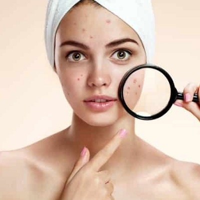 Unveiling the Path to Radiant Skin: Effective Acne Scar Treatment Solutions