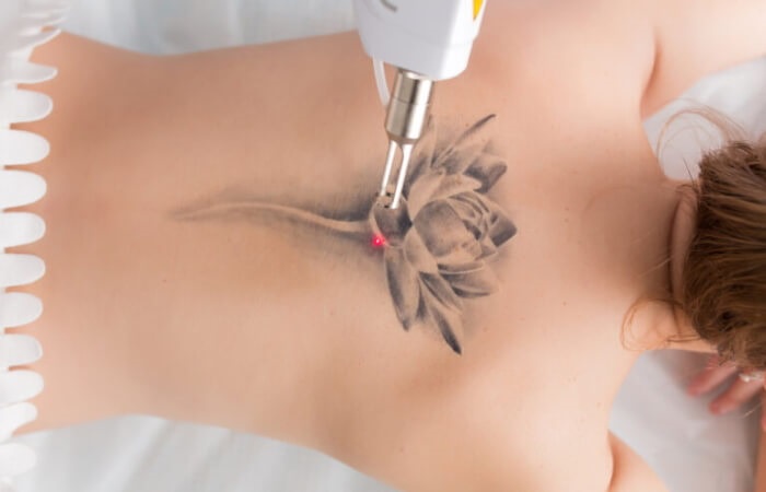 Beyond the Surface: Exploring Permanent Laser Tattoo Removal Technology