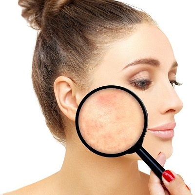 Banish Acne Scars: Effective Treatments for Clearer, Confident Skin