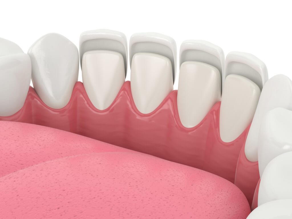 Dental Veneers: Your Ultimate Solution for a Picture-Perfect Smile