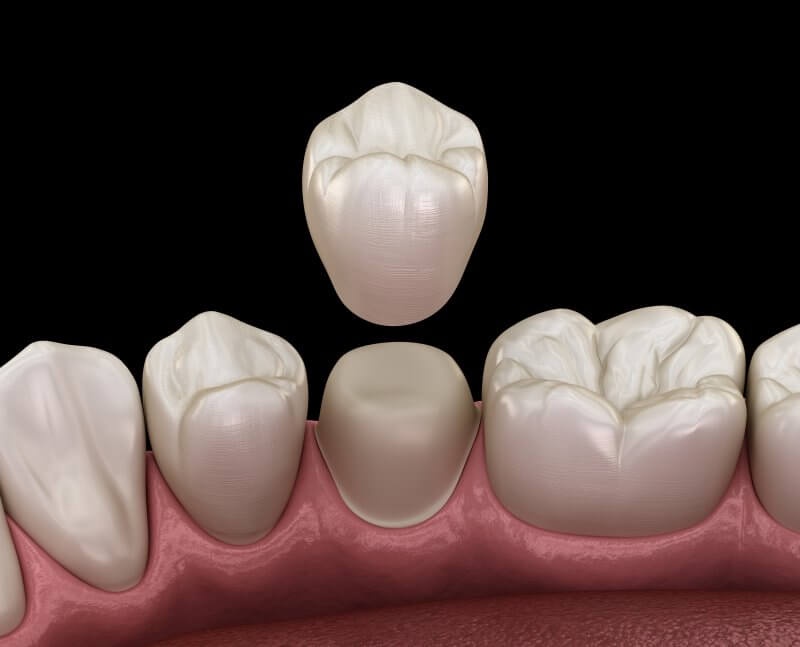 What Are Dental Crown Services And How Do They Work?