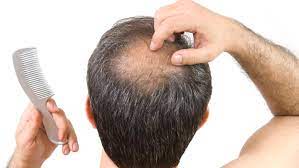 Enhance Your Confidence with DHI Hair Implantation in Dubai