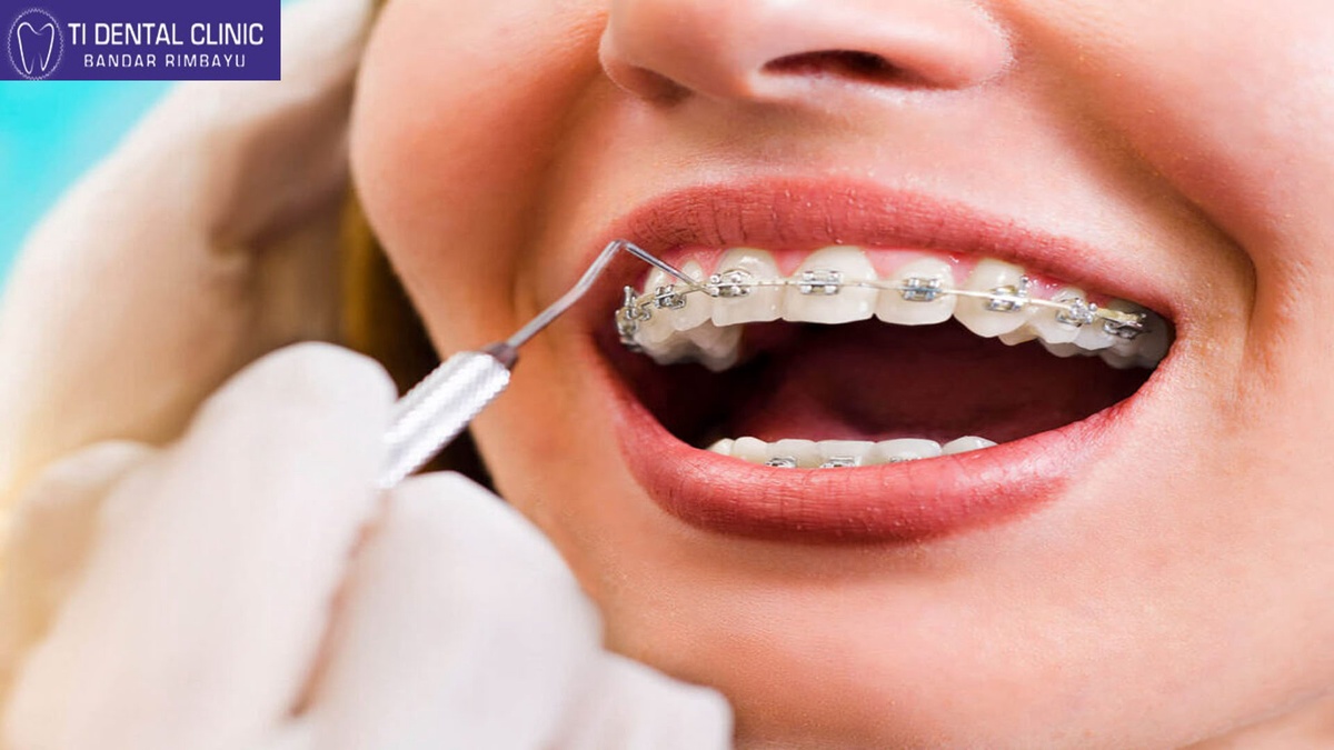 Teeth Veneers vs. Crowns: Which Is the Best Choice for You?