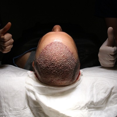 Your Ultimate Guide to Hair Transplant in Islamabad